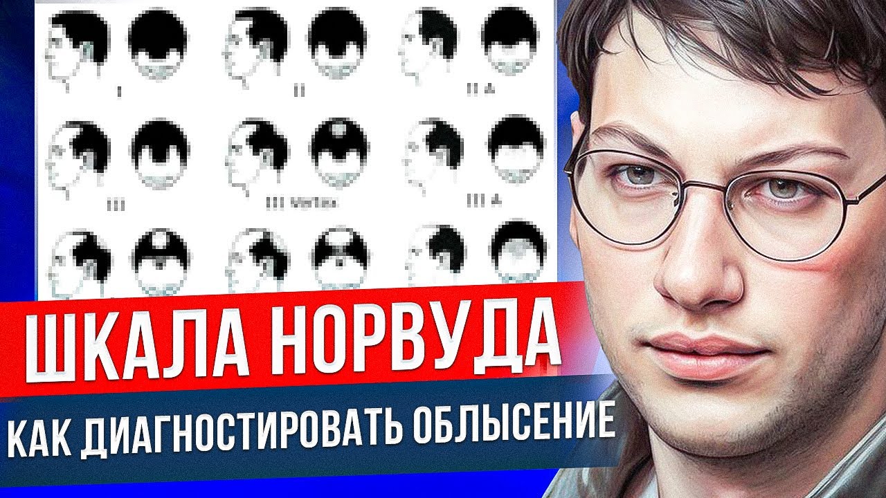 КАК ПОНЯТЬ ЧТО ЛЫСЕЕШЬ? | СТАДИИ ОБЛЫСЕНИЯ | ШКАЛА НОРВУДА ГАМИЛЬТОНА | МУЖСКОЕ ОБЛЫСЕНИЕ | ЗАЛЫСИНЫ