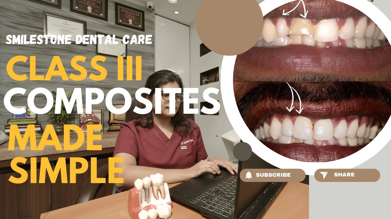 Mastering Class 3 Composites | 3 Techniques for Seamless Anterior Restorations|Dr Aparna Gupta