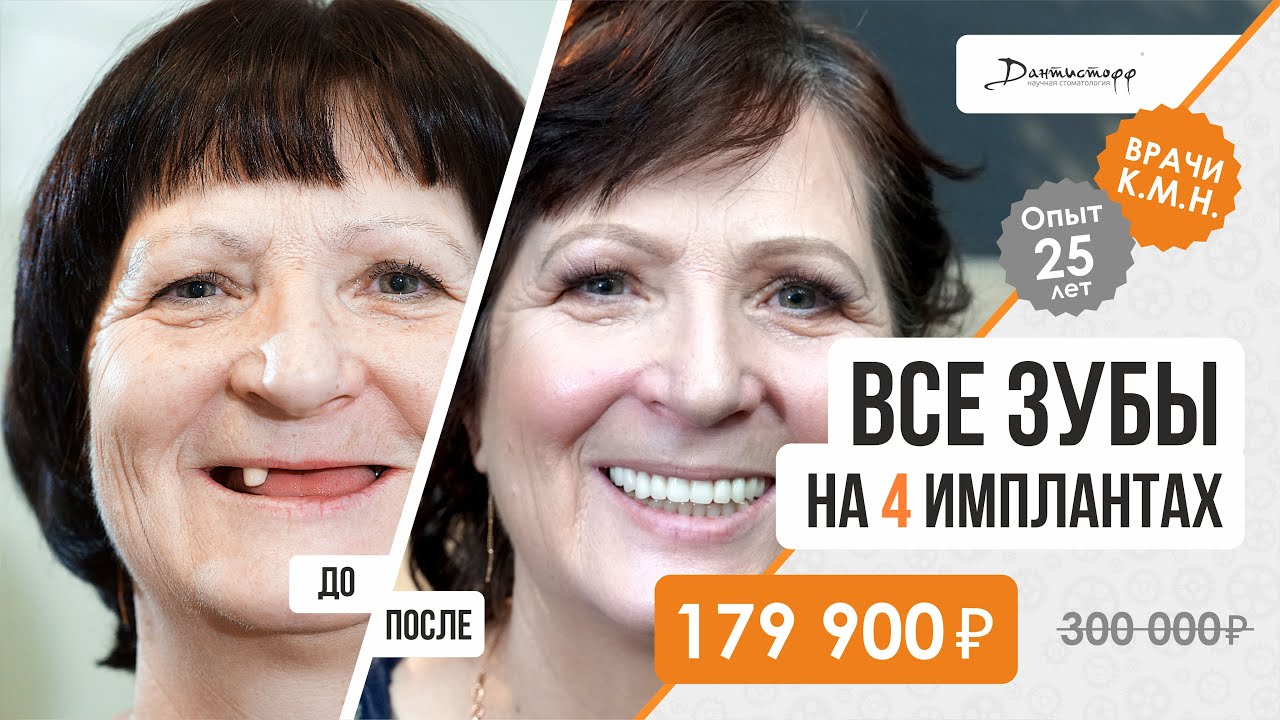 Восстановление всех зубов до/после. +7 (495) 255-59-37 Чудесное преображение пациентки! 18+