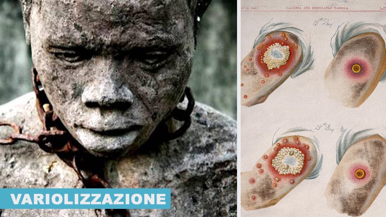 Onesimus: lo SCHIAVO che insegn&ograve; la VARIOLIZZAZIONE agli Stati Uniti