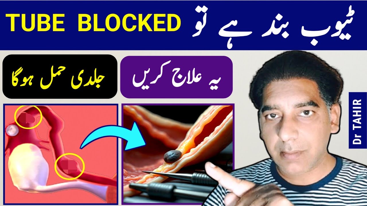 If Your Fallopian Tube is Blocked, You Can Follow This Procedure To Get Pregnant Fast