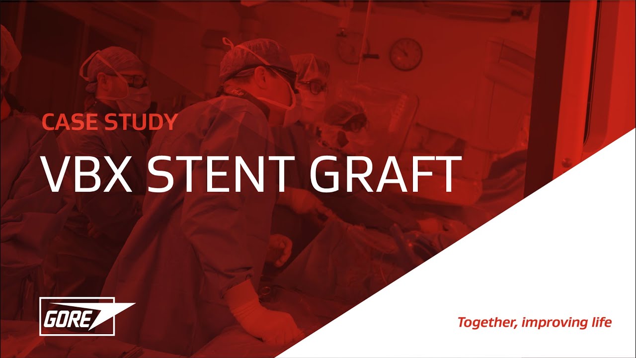 Case Study: A modern approach to iliac artery stenting with the VBX Stent Graft