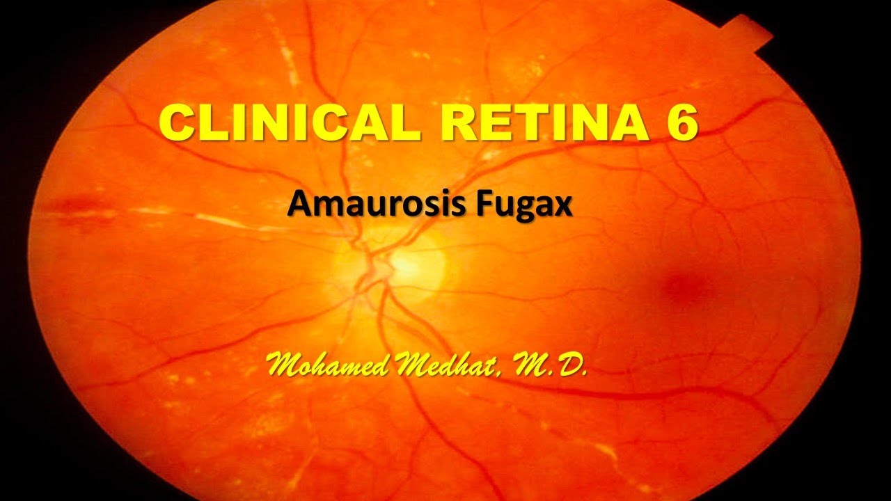 Clinical Retina 6 : Amaurosis Fugax
