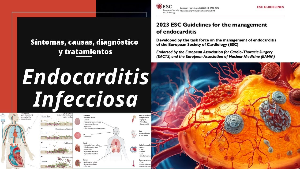 Endocarditis infecciosa, Lo ÚLTIMO según las guías ESC 2023