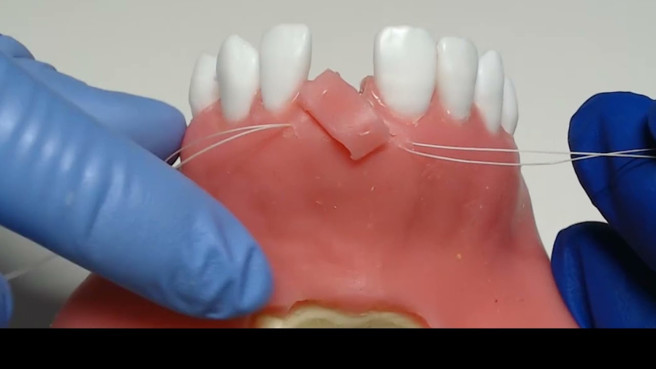 positioning suture and CT grafting via tunneling technique
