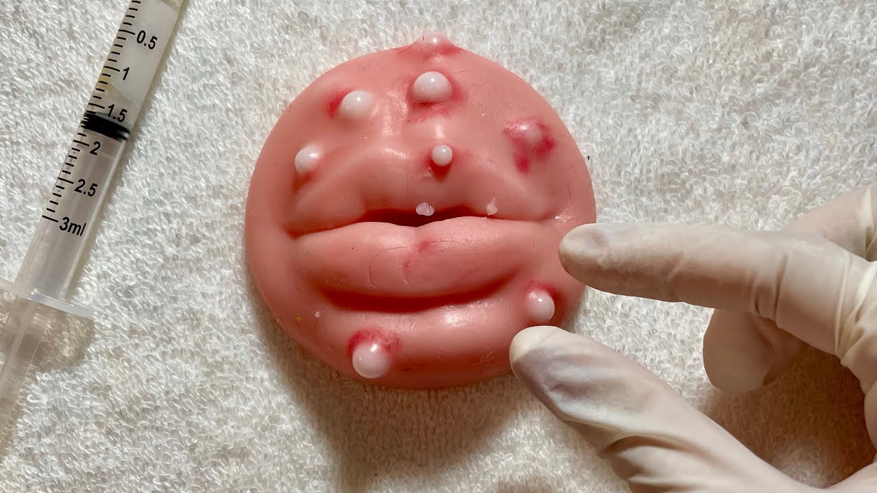 ASMR- REMOVENDO ESPINHAS E TRATAMENTO DE ACNES (DURMA AQUI)