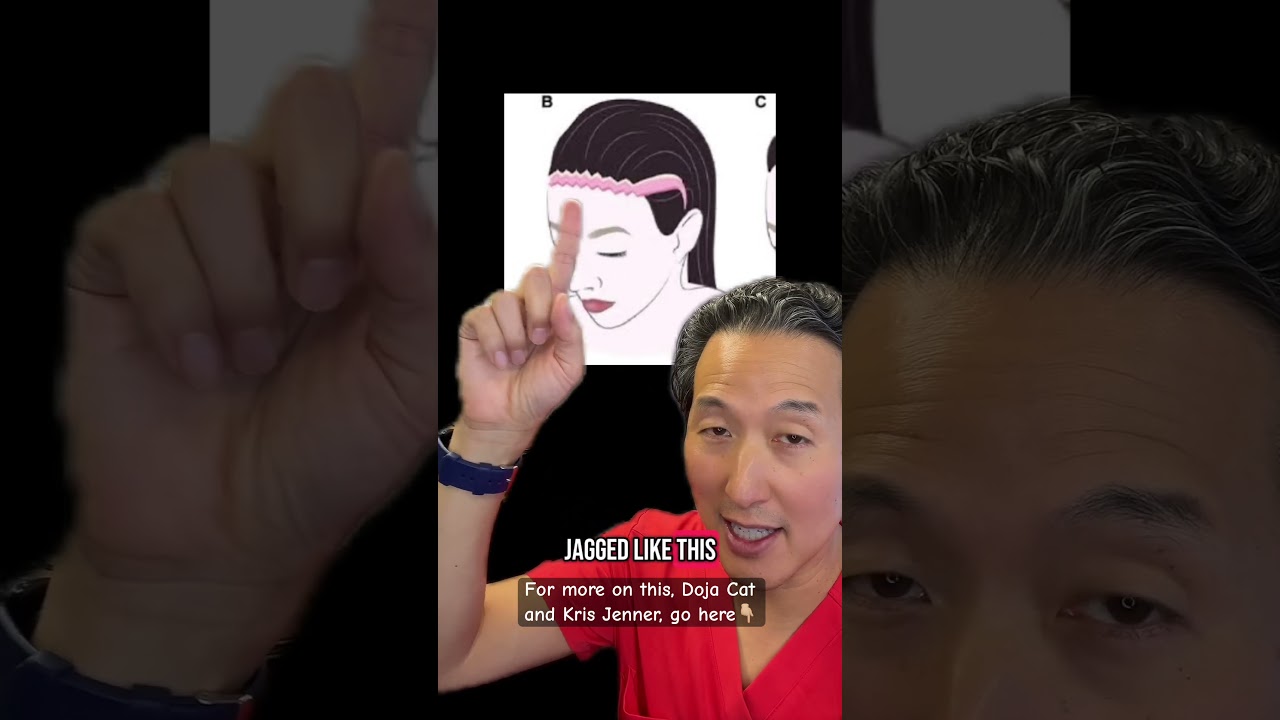 Chrissy Teigen’s Hairline Lowering Surgery!