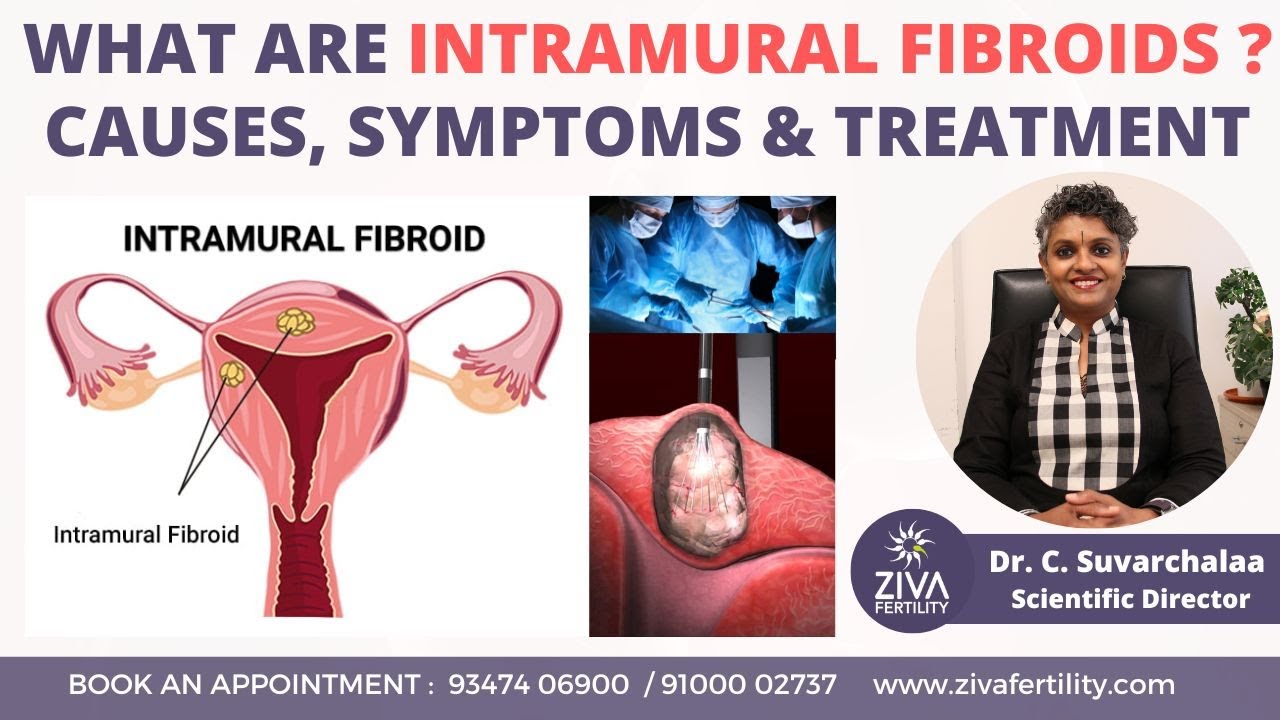 Intramural Fibroid : Causes, Symptoms and Treatment || Dr C Suvarchalaa || ZIVA Fertilityy