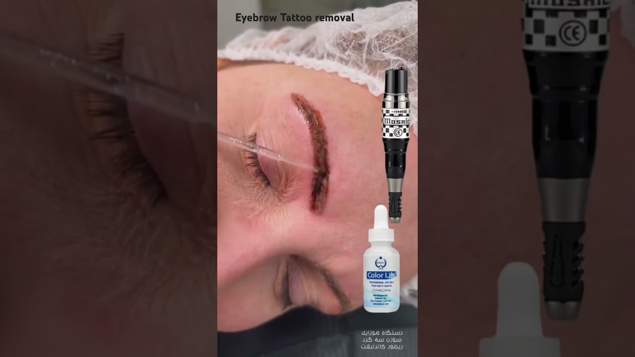 Eyebrow tattoo removal with color lift solution