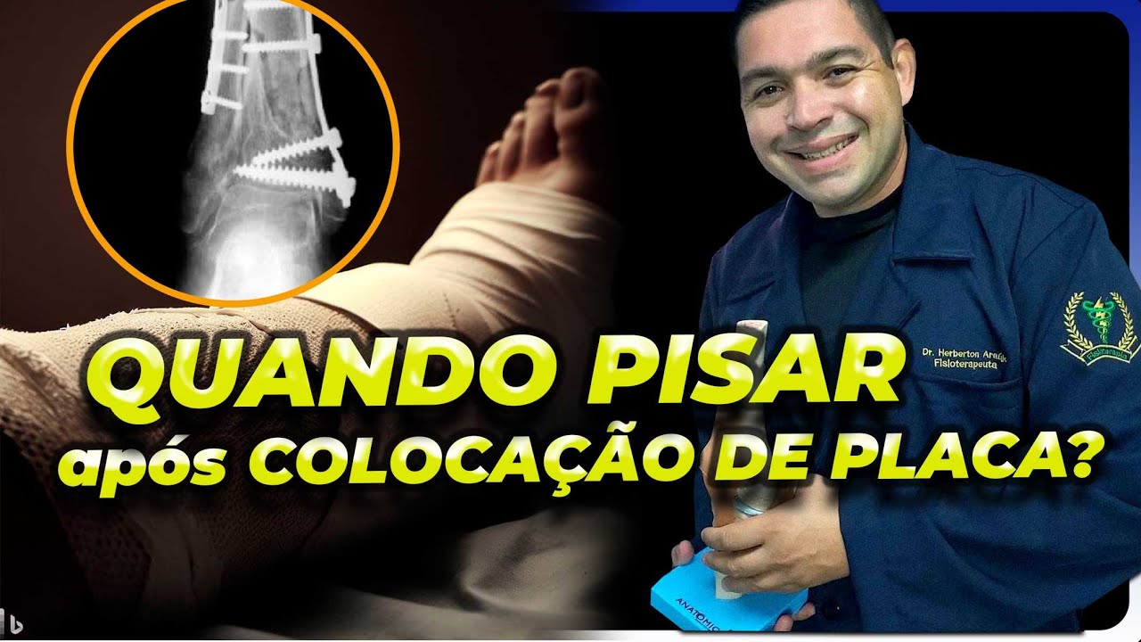 QUANDO COMEÇAR a PISAR APÓS CIRURGIA de FRATURA COM PLACA?