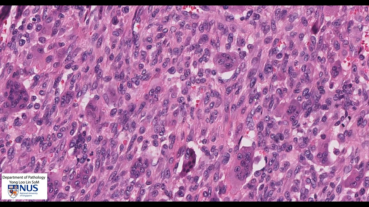 Bone: Giant cell tumour - Talking slide