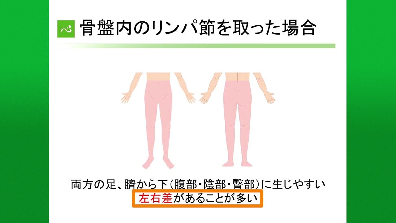 下肢のリンパ浮腫とそのケア