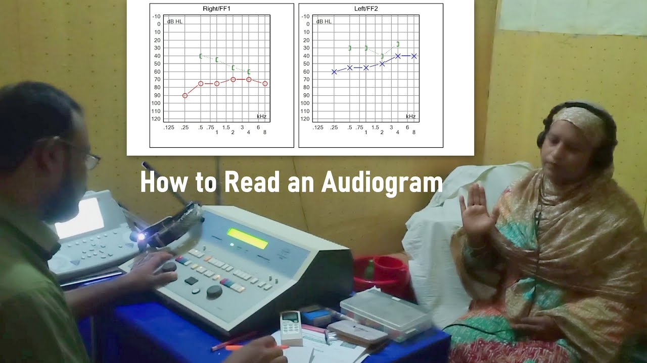 Pure Tone Audiometry: How it is Done. How to Interpret a Pure Tone Audiogram