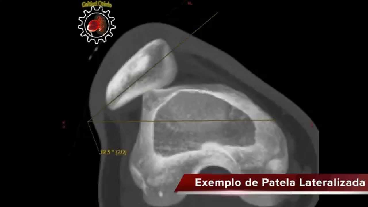 TA-GT - Medidas para Instabilidade Femoropatelar