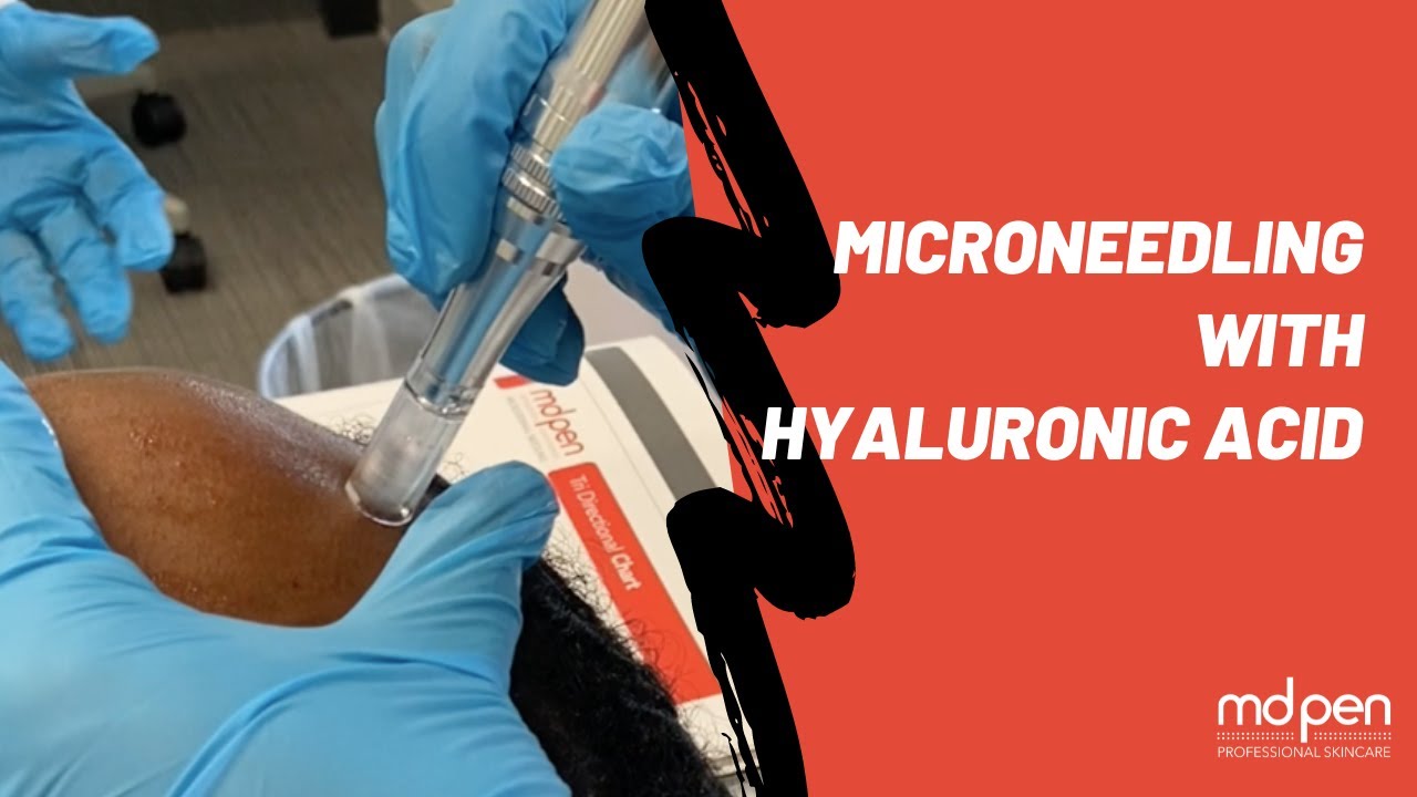 Microneedling with Hyaluronic Acid for Rich Hydration