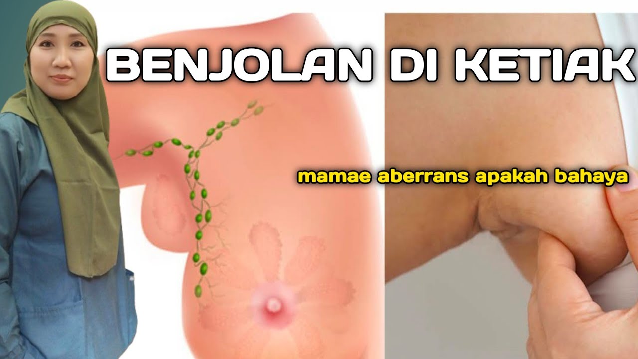 Payudara tumbuh di ketiak kok bisa? Mamae aberrans