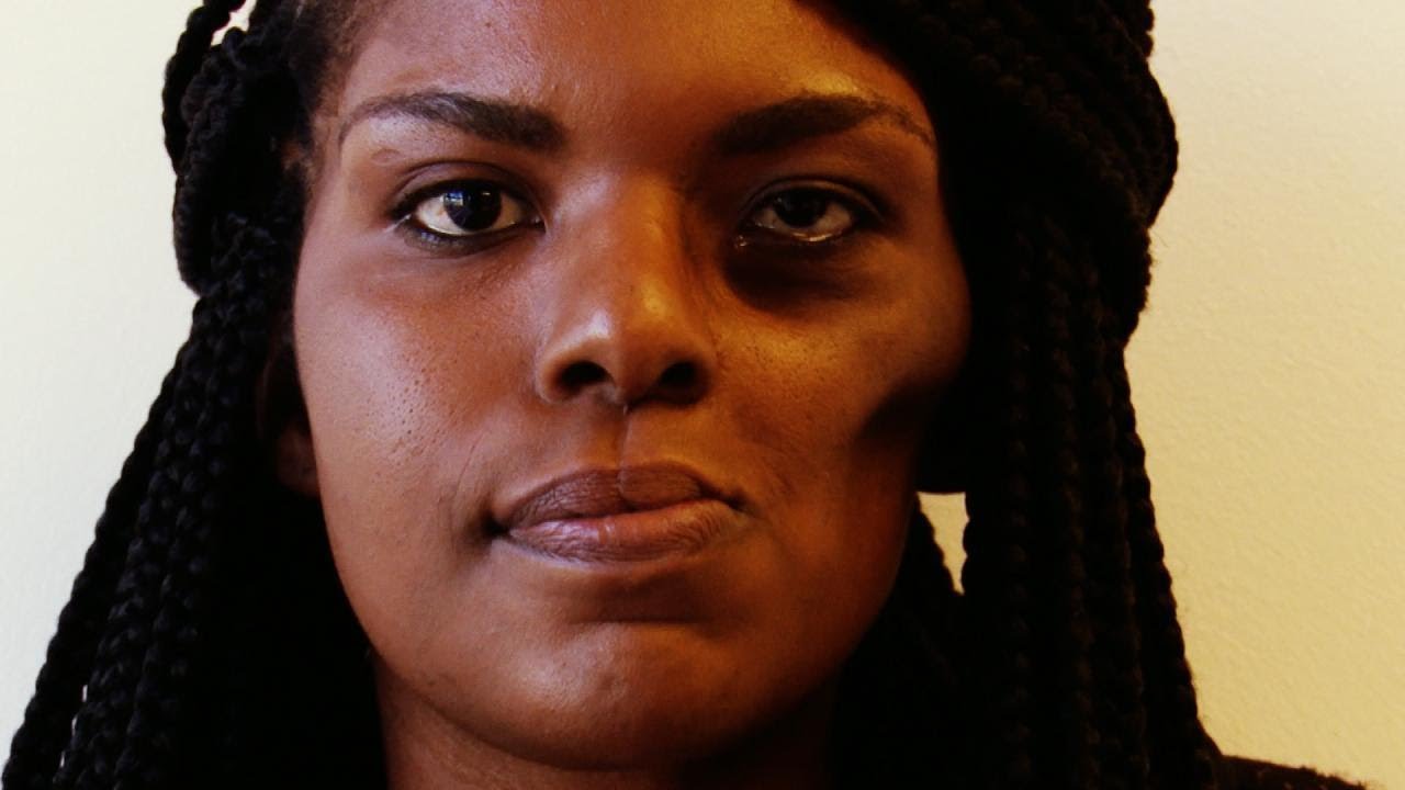 Drs. Exclusive: Cancer Left Me Disfigured