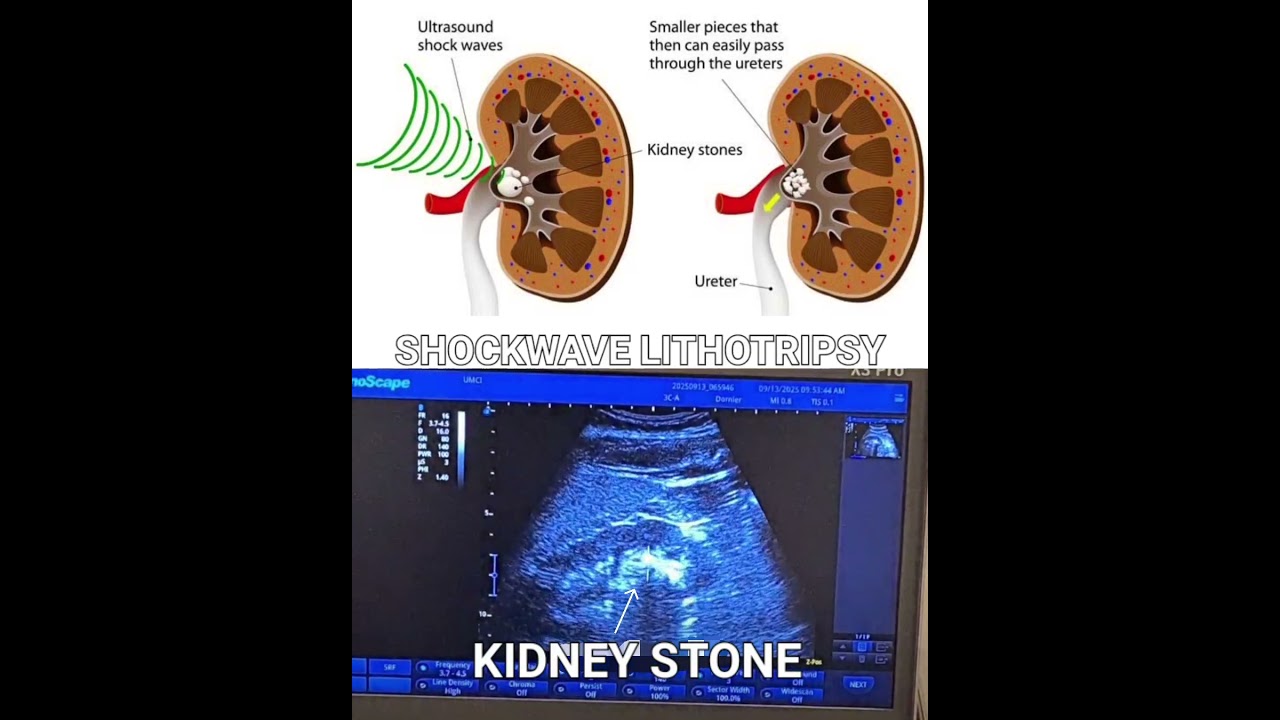 How ESWL (Extracorporeal Shockwave Lithotripsy) works?