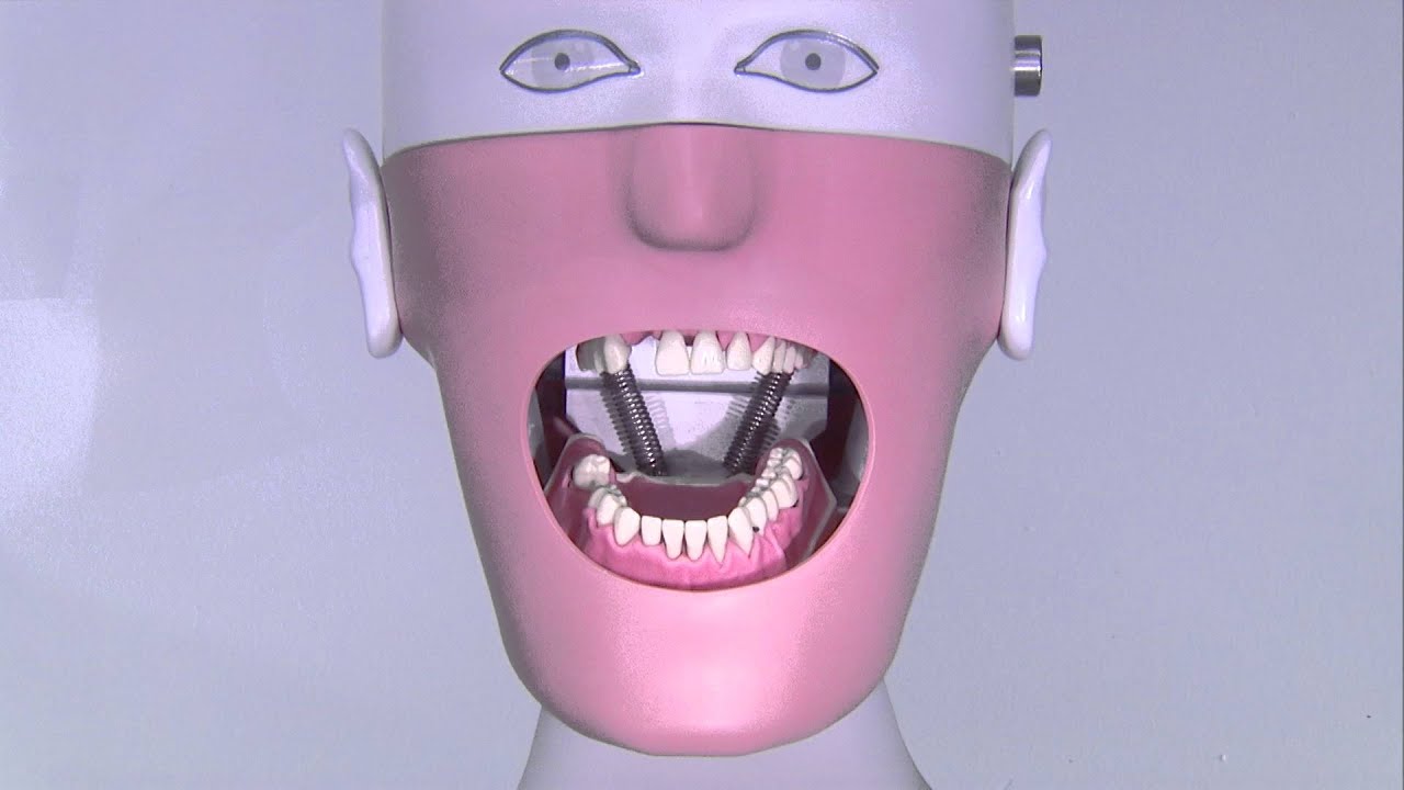 Alginatabformung