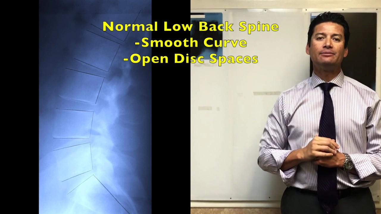 Fix Spine, Fix Pain. Javier X Ray Analysis. Upland Claremont Cucamonga Chiropractor