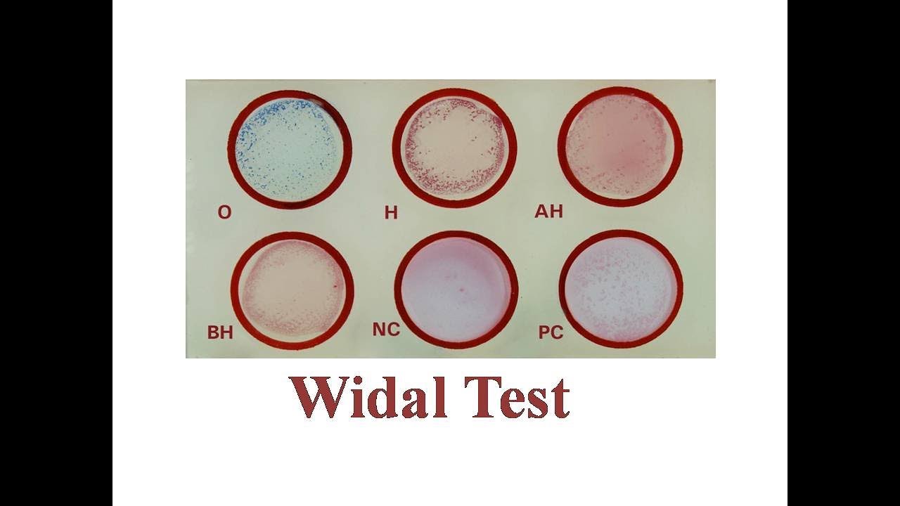 Widal Test ~~ Slide and Tube Full Procedure