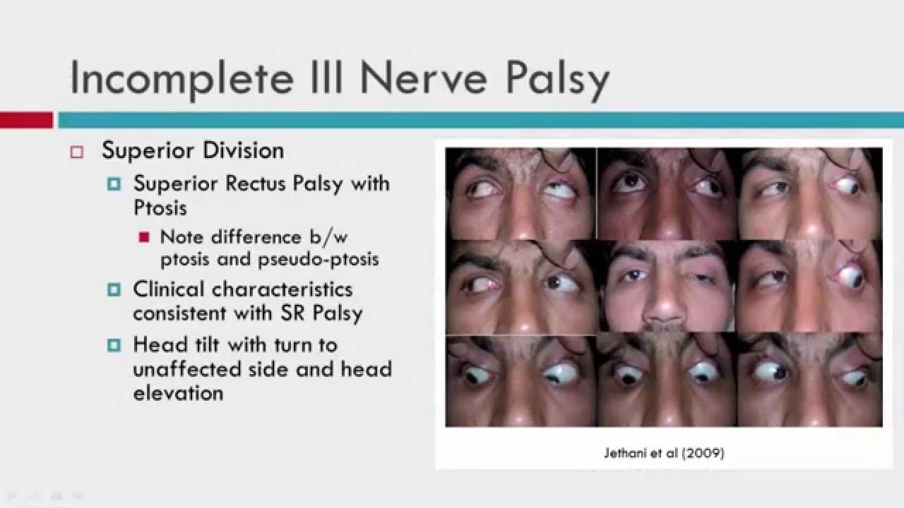IIIrd CN Palsy Clinical Characteristics