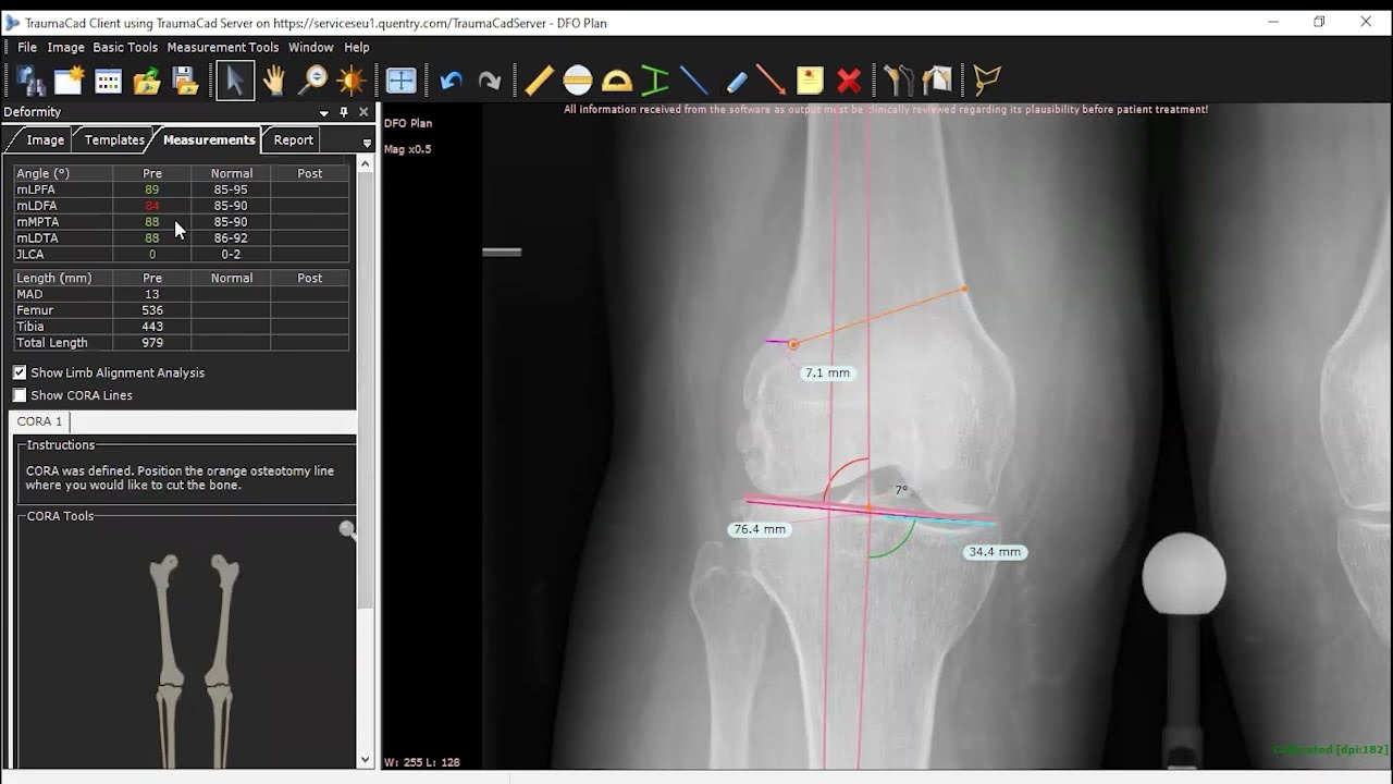 Knee Osteotomy Planning For Beginners