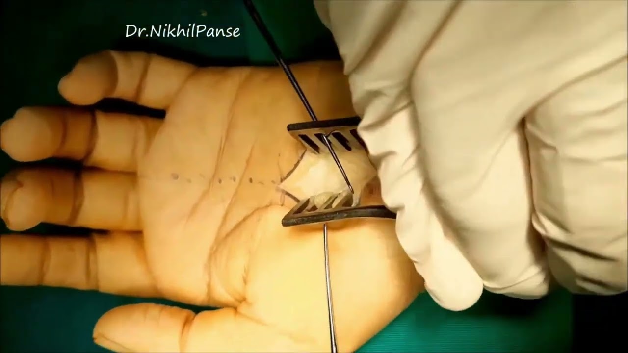 Carpal tunnel release