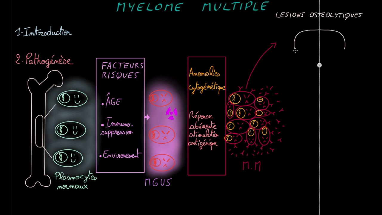Myélome multiple  - Docteur Synapse