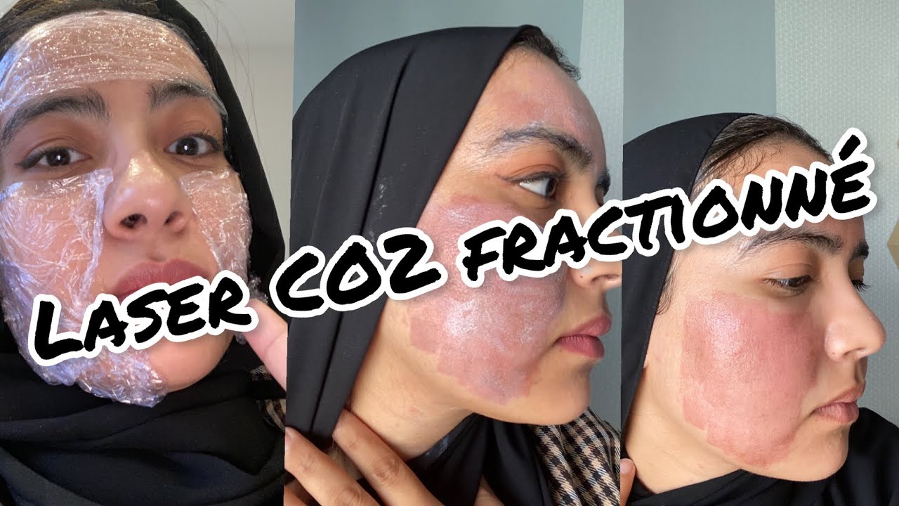 Mon expérience avec Laser CO2 fractionné(review 8 days)/تجربتي مع تقنية لازير لإزالة آثار حب الشباب