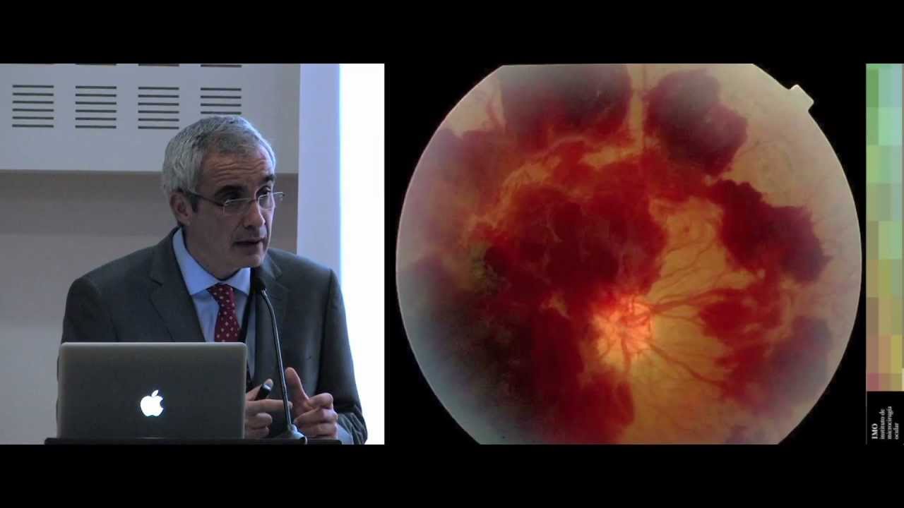 Diabetes y Visión (1) Síntomas y prevención. Dr. Navarro de IMO Barcelona