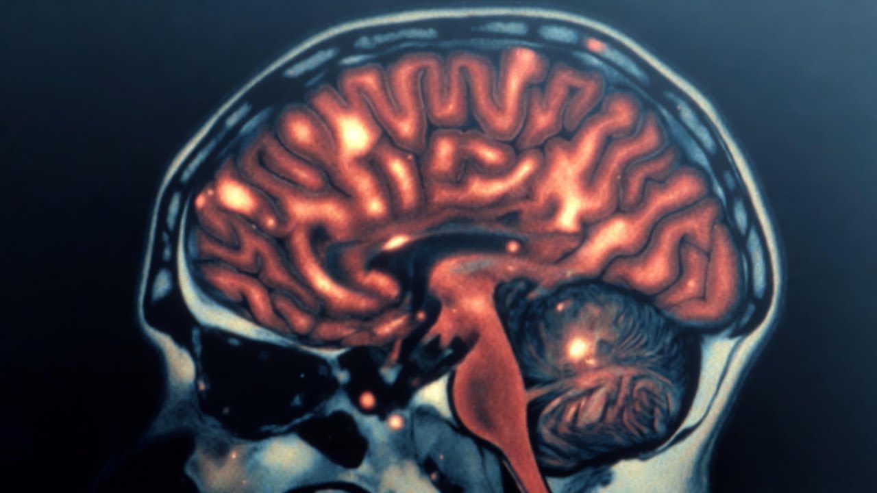 Evaluación del estado de coma:  Guia de la Academia Europea de Neurología.