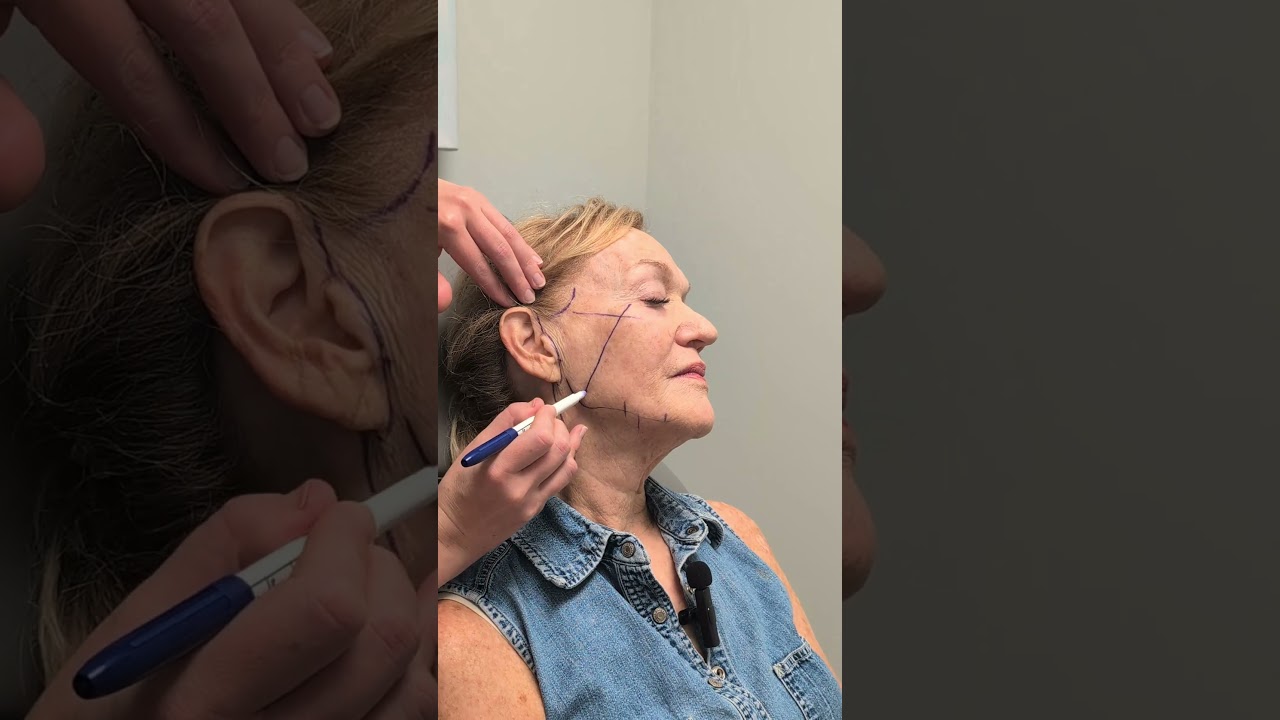 Marking for a deep plane facelift and neck lift