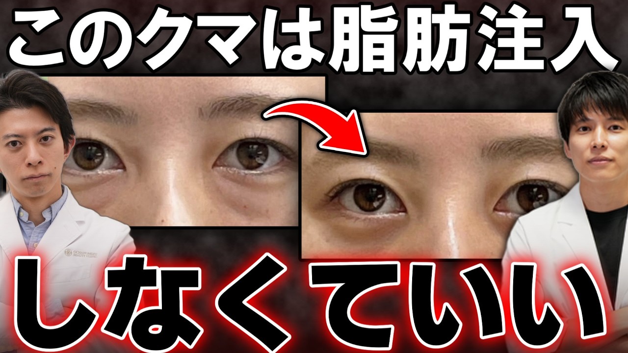 【失敗しないために】クマ取りで「脱脂＋脂肪注入」は断ってもいい？同時にやるべき本当の理由をリスク、デメリットを踏まえて解説。【目の下のクマ治療/目の下のくぼみ/アンチエイジング】