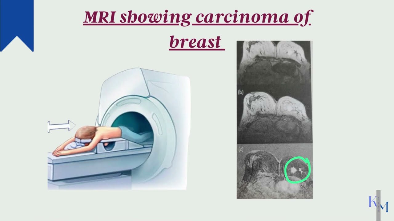 Triple Assessment of breast | Examination, Imaging and Histopathology | Bailey&Love