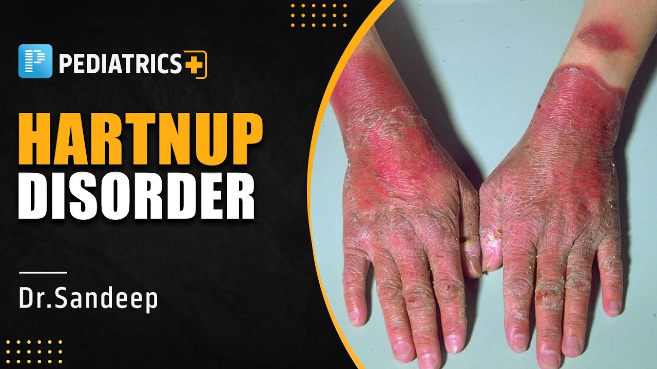Hartnup Disorder by Dr. Sandeep Sharma | PrepLadder NEET SS