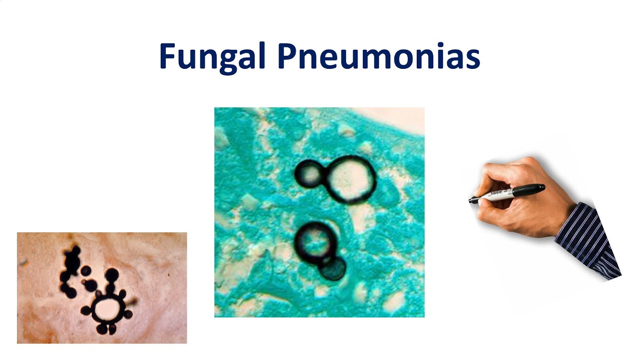 Fungal Pneumonia Made Simple