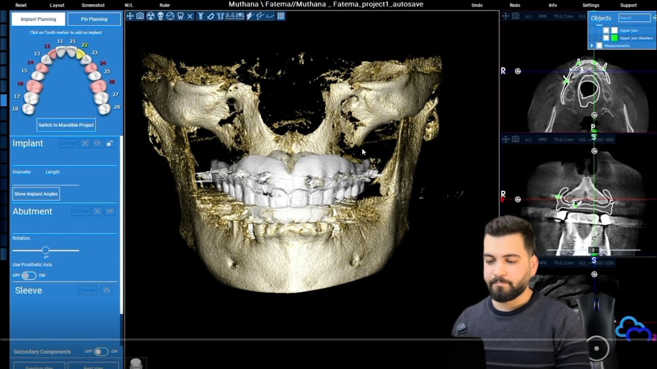 Dual scan or Double scan in Real Guide software for edentulous patient