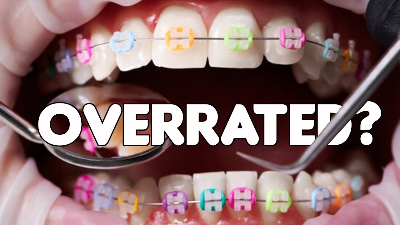 Are Braces REALLY Worth It?
