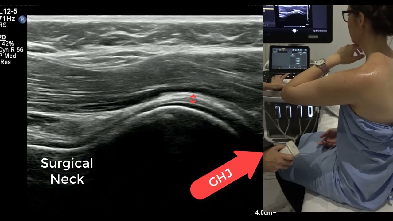 Ультразвуковое сканирование плеча в реальном времени — динамическая вращательная манжета и задняя...