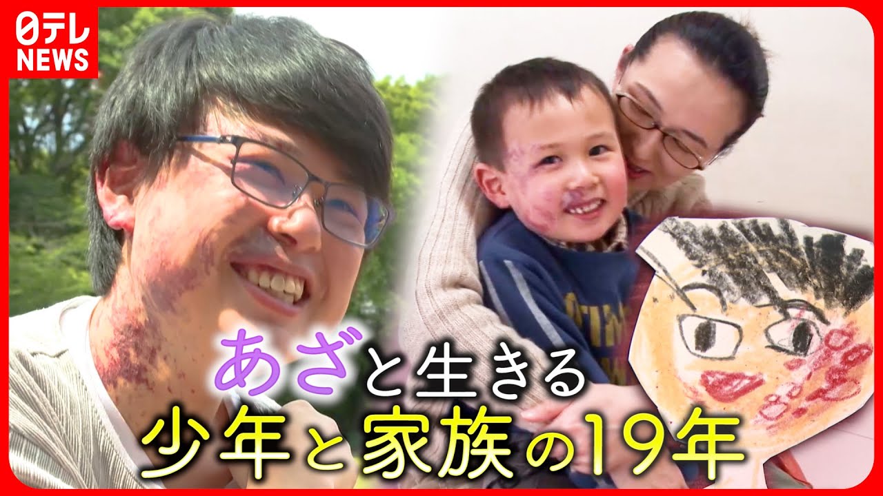 【難病】医学部へ進学！顔の