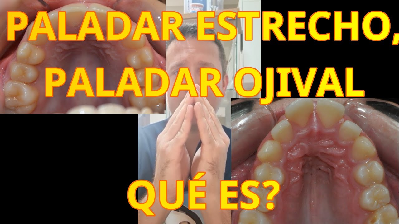 Paladar estrecho &iquest;qu&eacute; es?, &iquest;qu&eacute; problemas tiene?