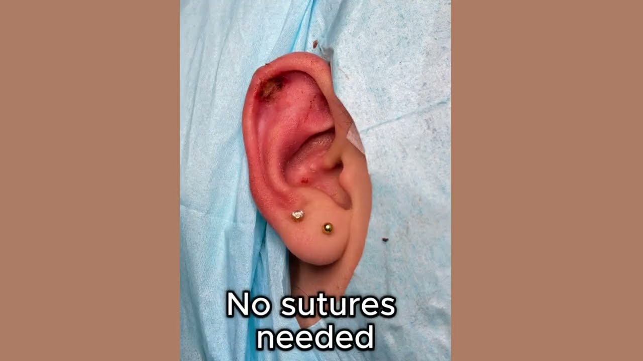 Earlobe keloid Removal Keloid Removal * Scar free Keloid Removal |#Keloi #earloberepair #california