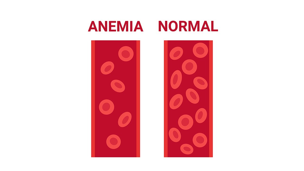 Anemia in Pregnancy
