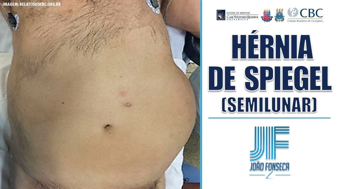 HÉRNIAS ABDOMINAIS (Parte 6): SPIEGEL (SEMILUNAR) 👨🏽‍⚕️🚑 Joao Fonseca (Cir. Geral)