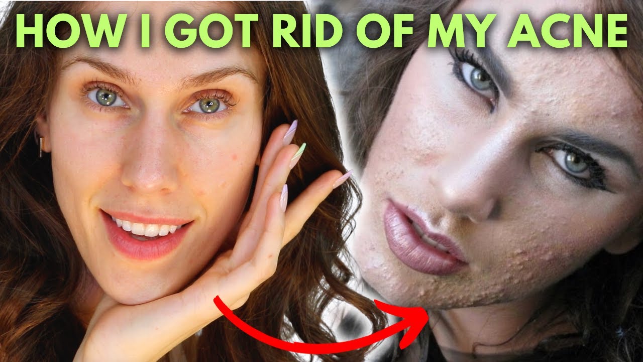 3 Acne Destroying Skincare Tips I Wish I knew When I was 16