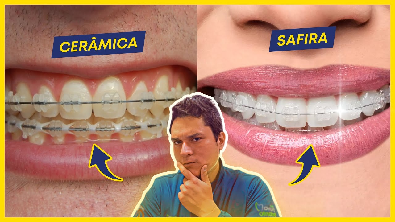 APARELHO DE CERÂMICA X SAFIRA: QUAL O MELHOR? (A VERDADE).