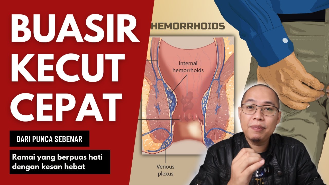 Cara Cepat Mengatasi Buasir Yang Sakit, Pedih & Gatal. Berkesan!