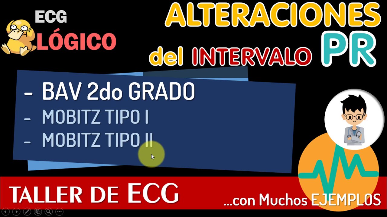 BLOQUEO AURICULO VENTRICULAR DE 2do GRADO