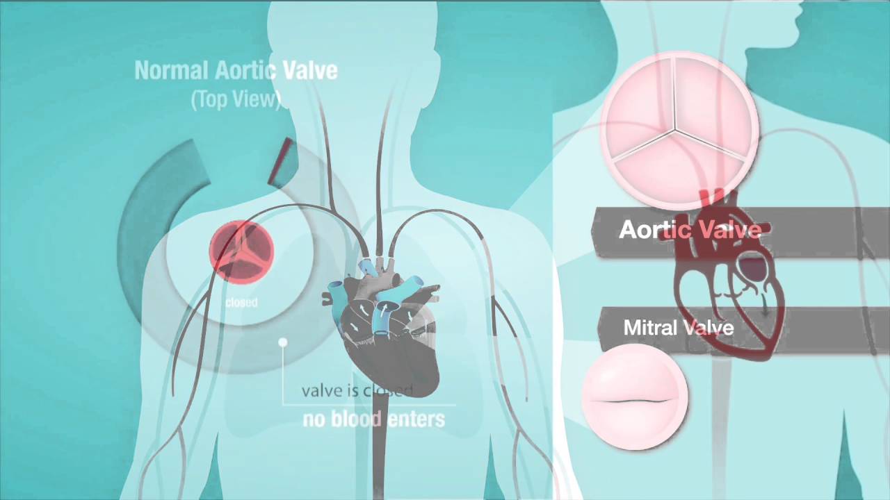Understanding Heart Murmurs, Aortic and Mitral Valve Problems